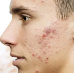 Moisturizing creams